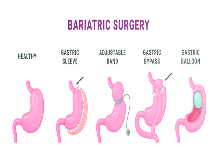 Bariatric Surgery